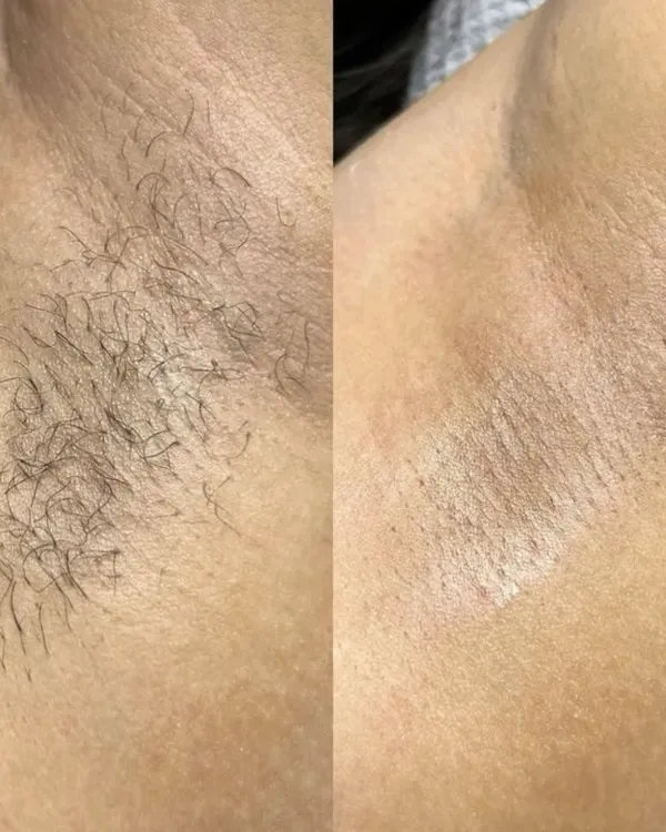 Antes e depois de depilação nas axilas: à esquerda com pelos, à direita com a pele lisa